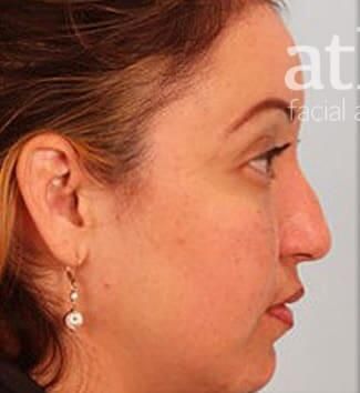 Rhinoplasty Before & After