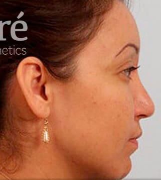 Rhinoplasty Before & After