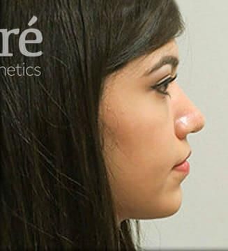 Rhinoplasty Before & After