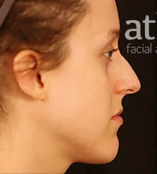 Rhinoplasty Before & After