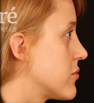 Rhinoplasty Before & After