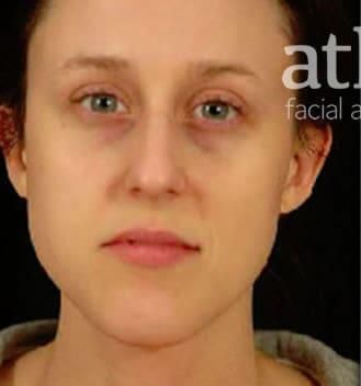 Rhinoplasty Before & After