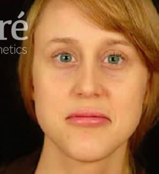 Rhinoplasty Before & After