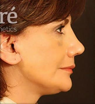 Rhinoplasty Before & After