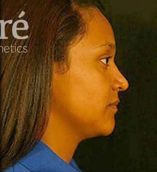 Rhinoplasty Before & After