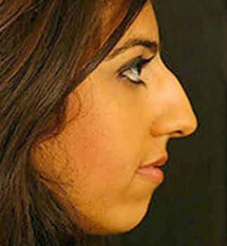 Rhinoplasty Before & After