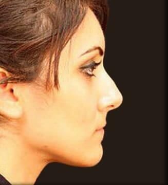 Rhinoplasty Before & After