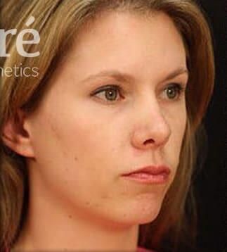 Rhinoplasty Before & After