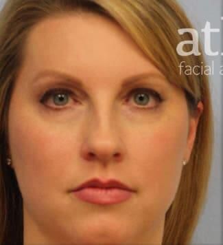 Rhinoplasty Before & After