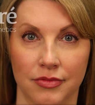 Rhinoplasty Before & After