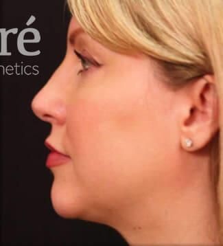 Rhinoplasty Before & After
