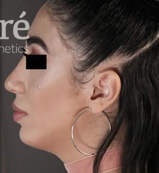 Rhinoplasty Before & After