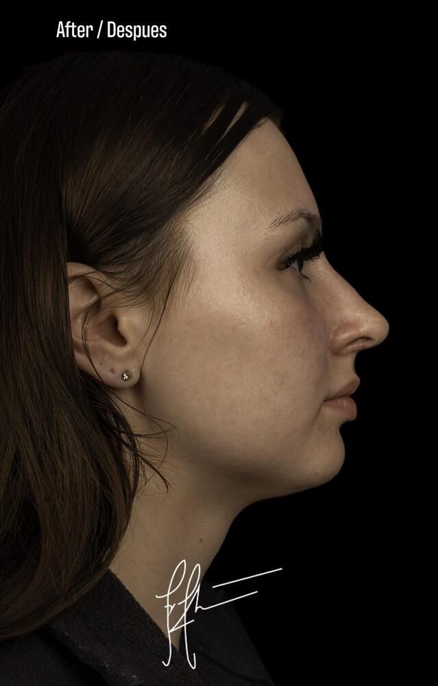 Rhinoplasty Before & After