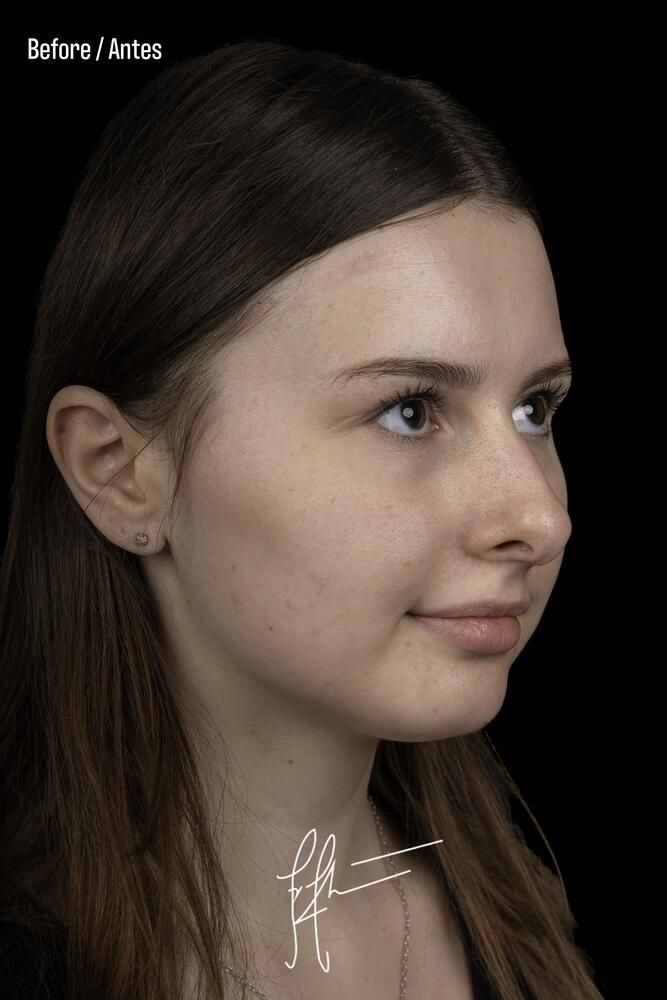 Rhinoplasty Before & After