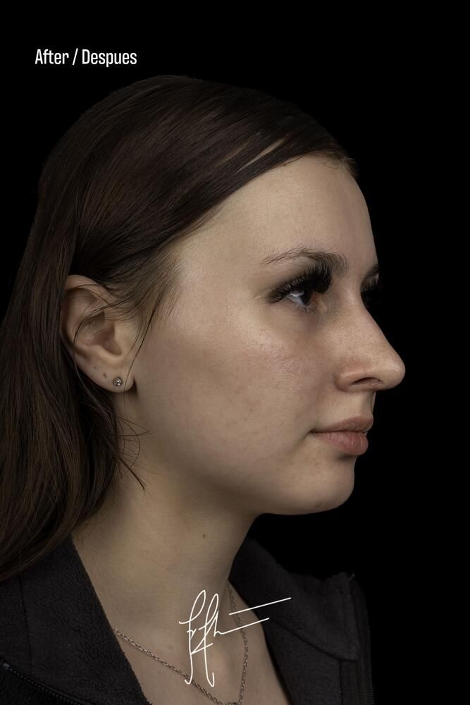 Rhinoplasty Before & After
