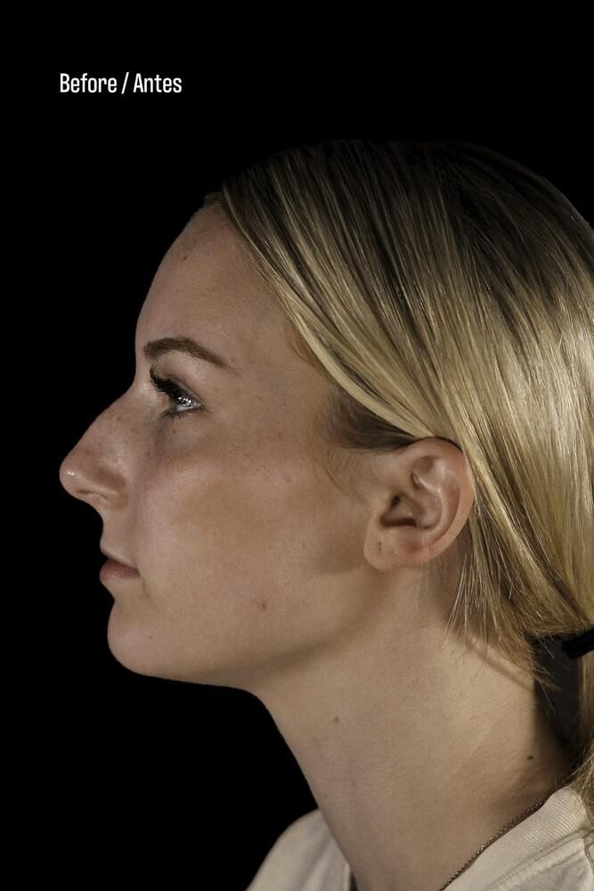 Rhinoplasty Before & After