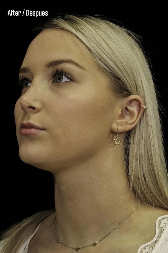 Rhinoplasty Before & After