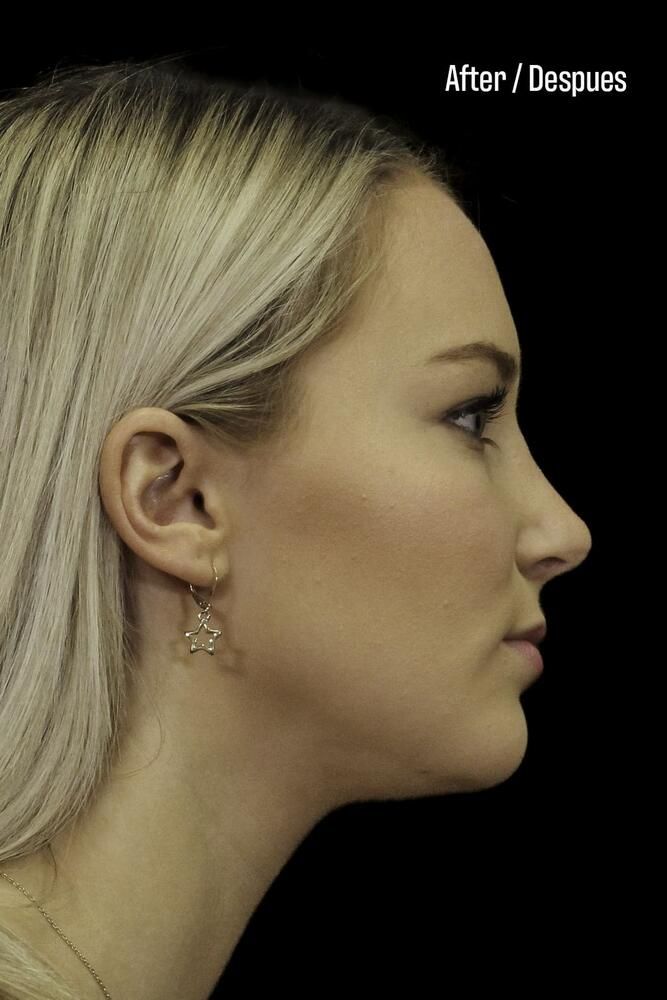 Rhinoplasty Before & After