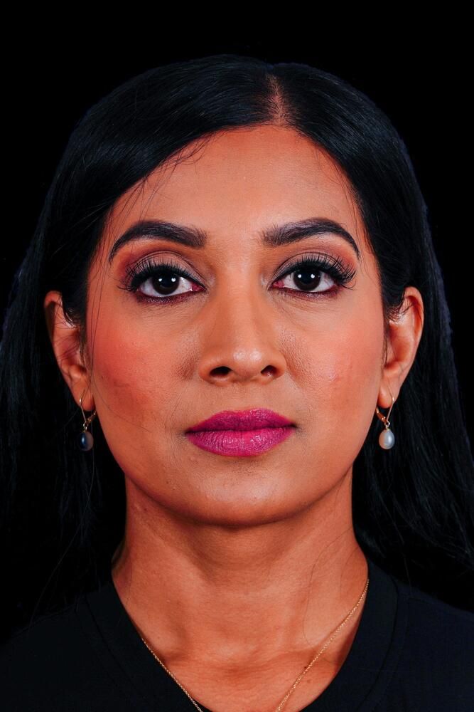 Rhinoplasty Before & After