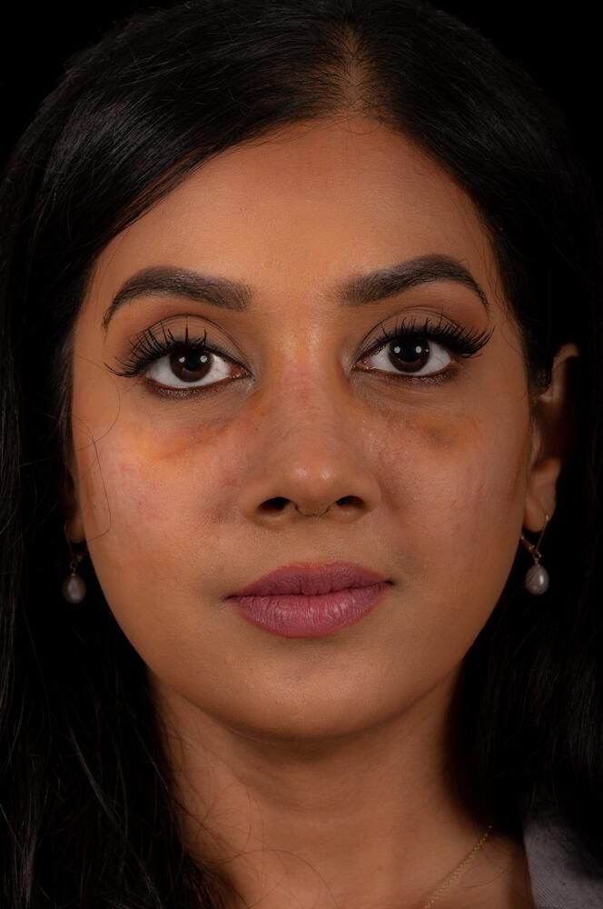 Rhinoplasty Before & After