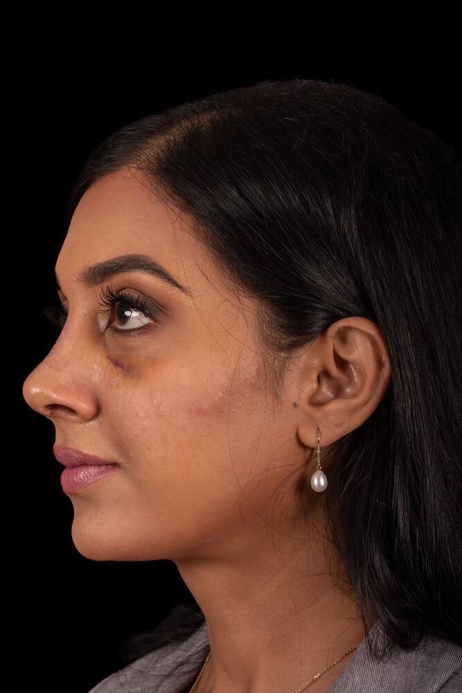 Rhinoplasty Before & After