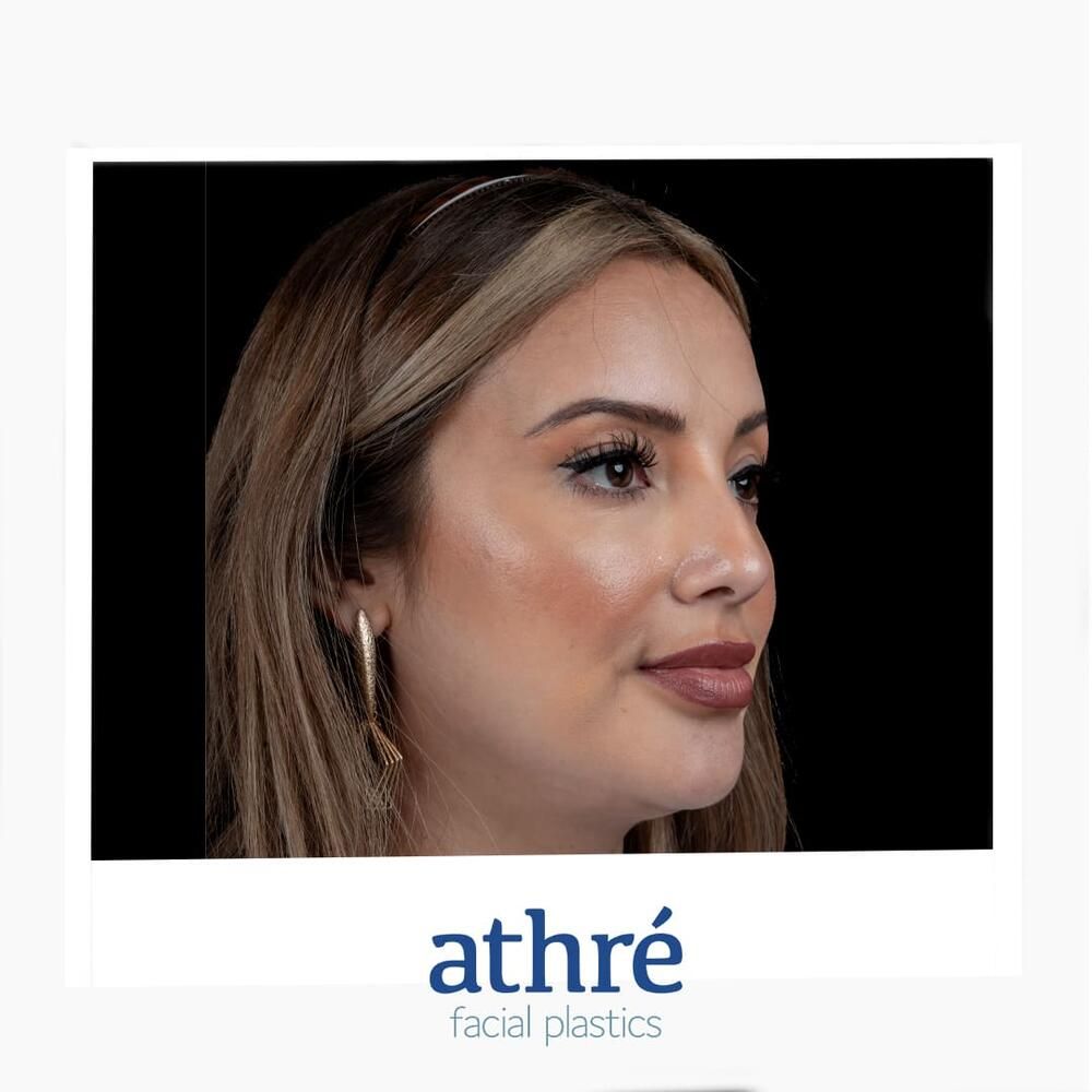 Rhinoplasty Before & After