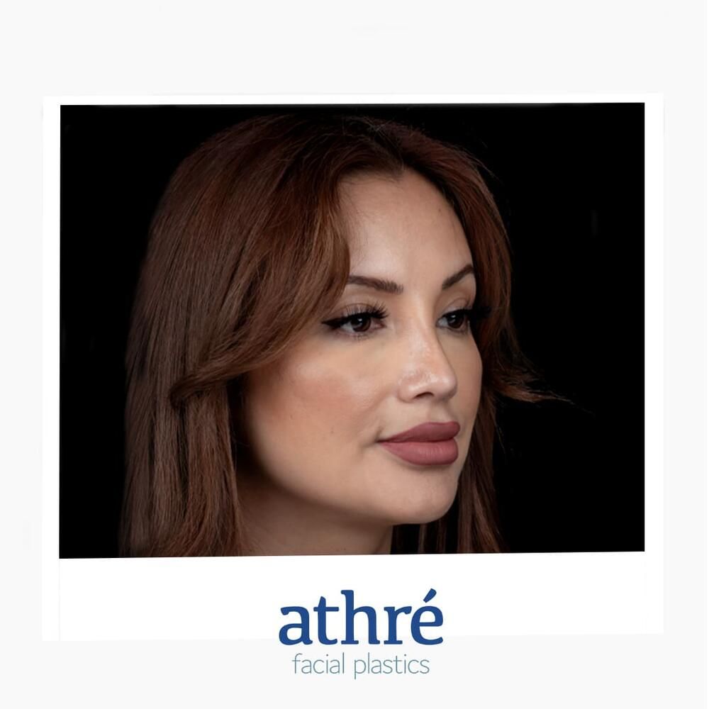 Rhinoplasty Before & After