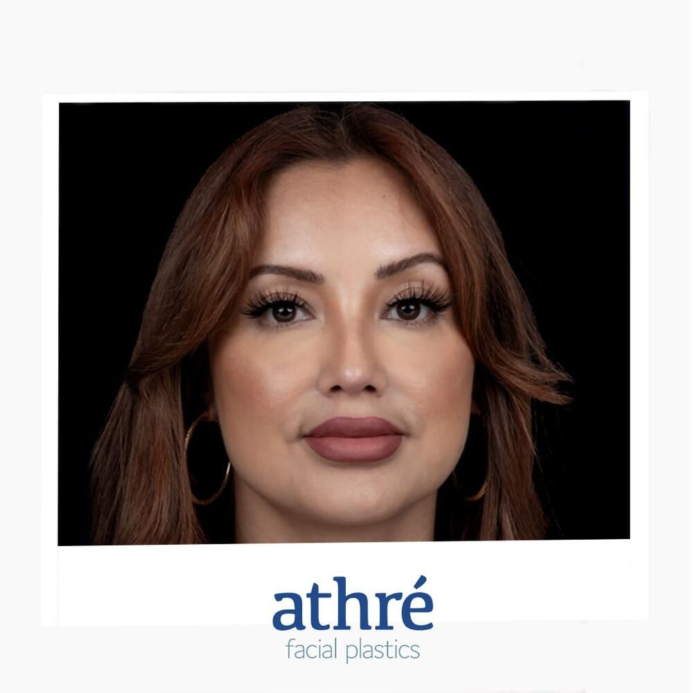 Rhinoplasty Before & After