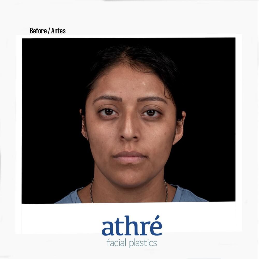 Rhinoplasty Before & After