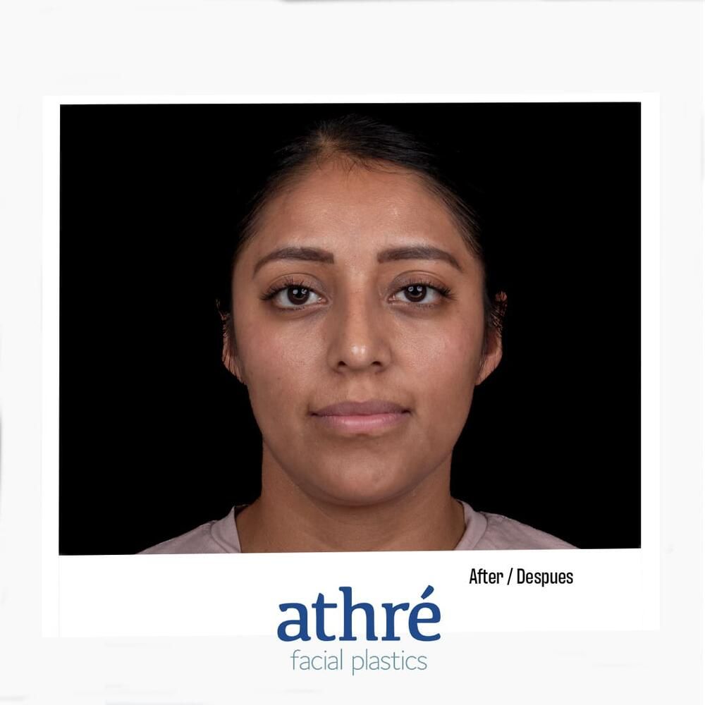 Rhinoplasty Before & After