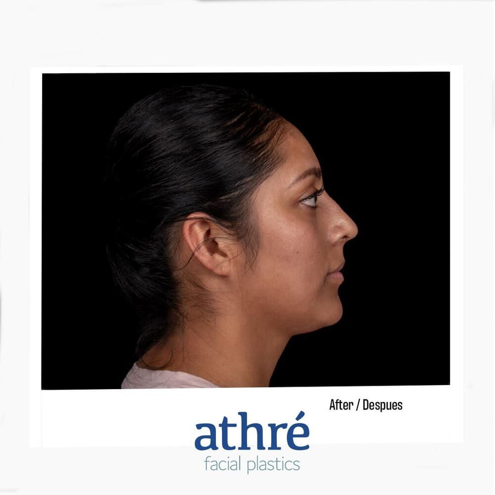 Rhinoplasty Before & After
