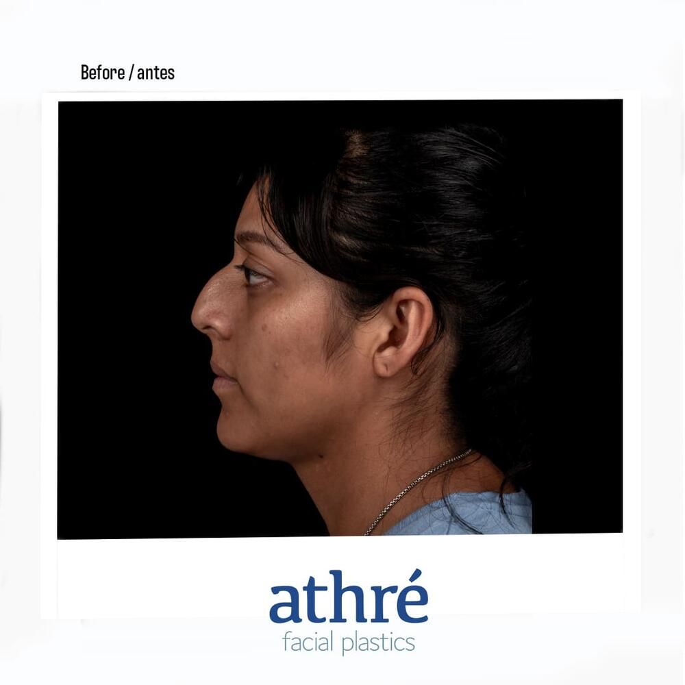 Rhinoplasty Before & After