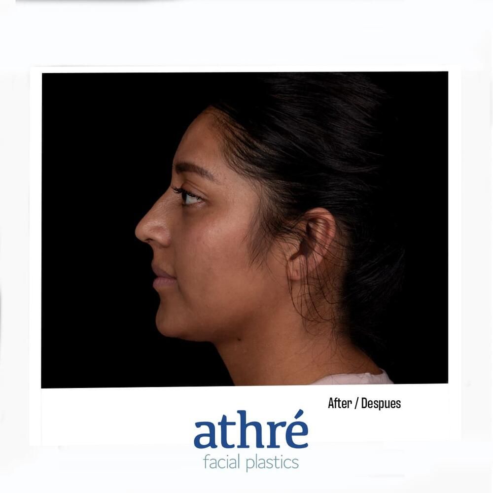 Rhinoplasty Before & After