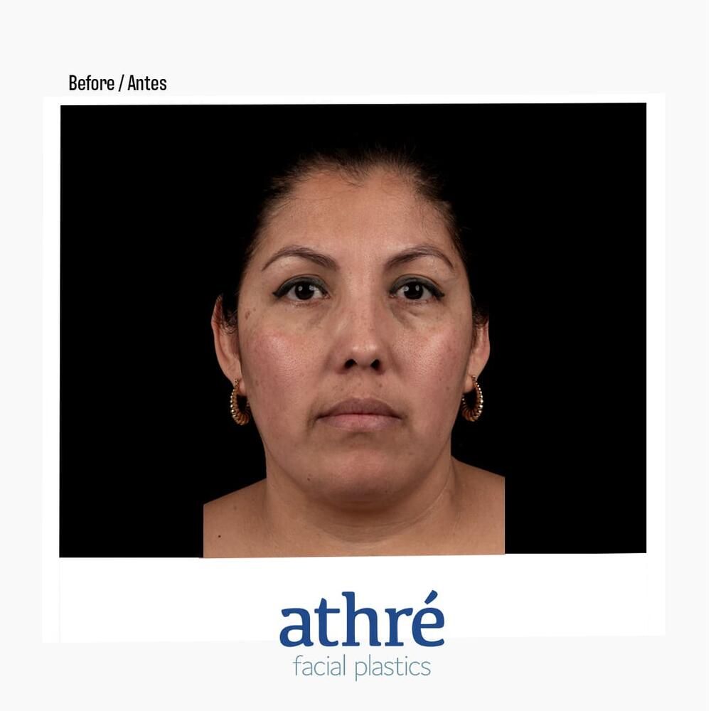 Rhinoplasty Before & After