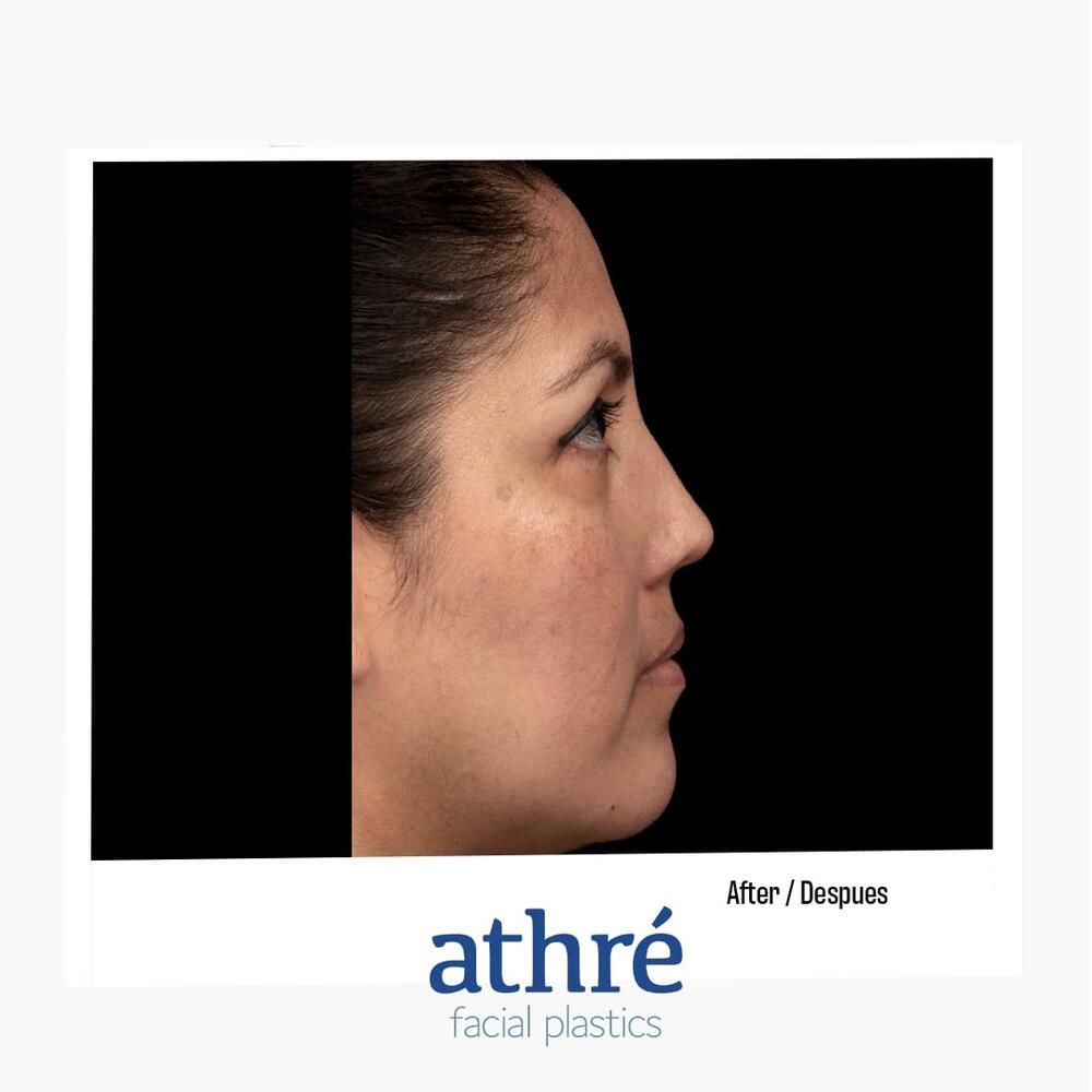 Rhinoplasty Before & After