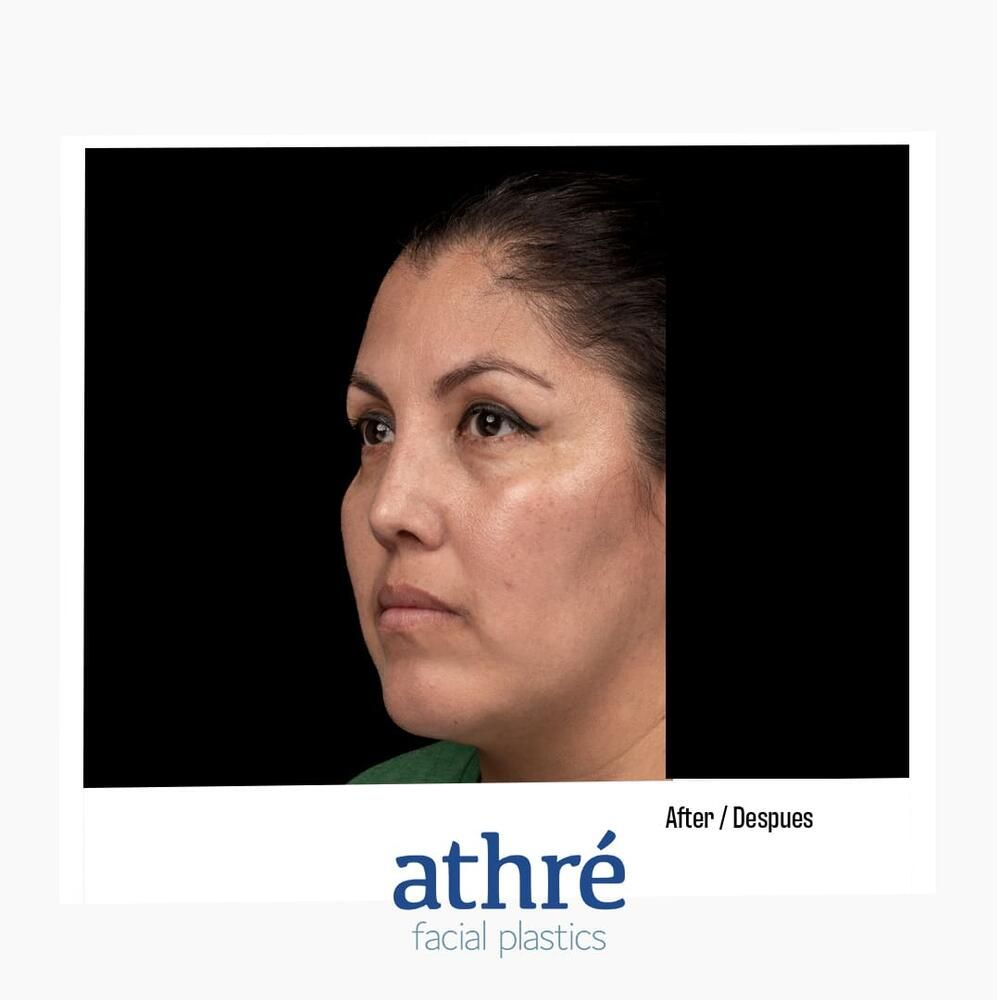 Rhinoplasty Before & After