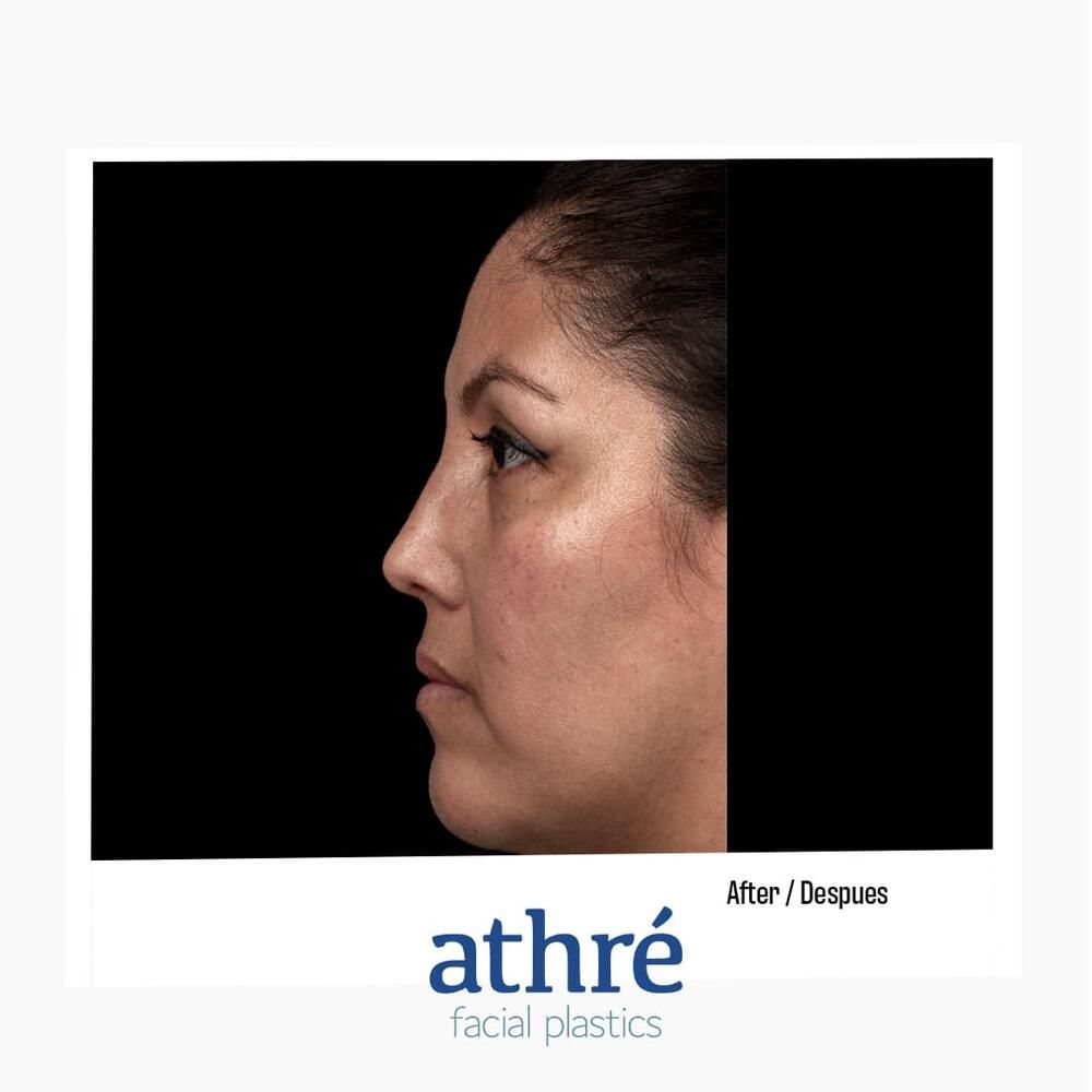 Rhinoplasty Before & After