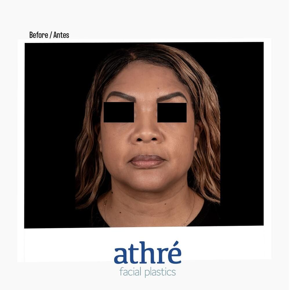 Rhinoplasty Before & After