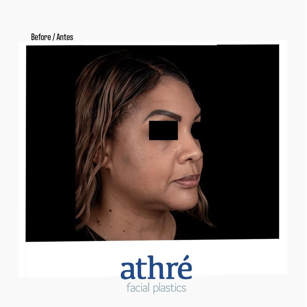 Rhinoplasty Before & After