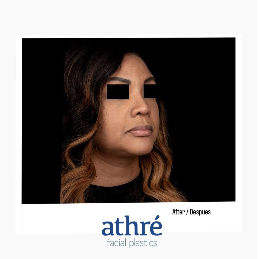 Rhinoplasty Before & After