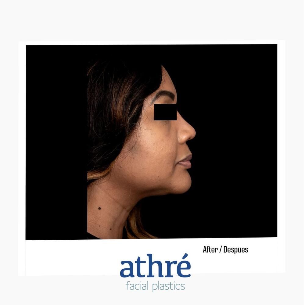 Rhinoplasty Before & After