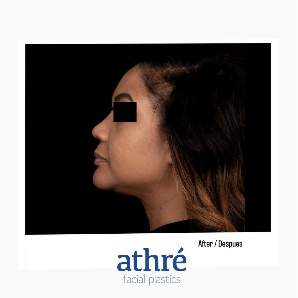 Rhinoplasty Before & After