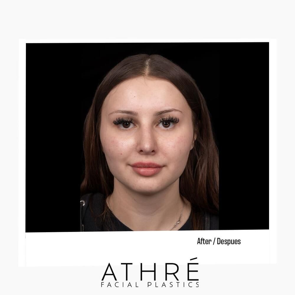 Rhinoplasty Before & After