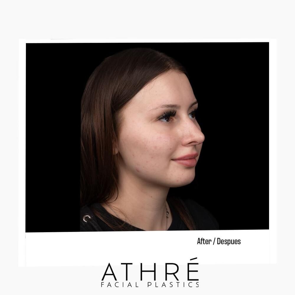 Rhinoplasty Before & After