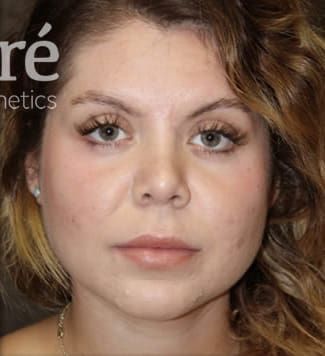 Revision Rhinoplasty Before & After
