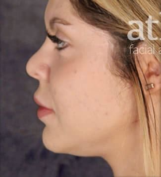 Revision Rhinoplasty Before & After