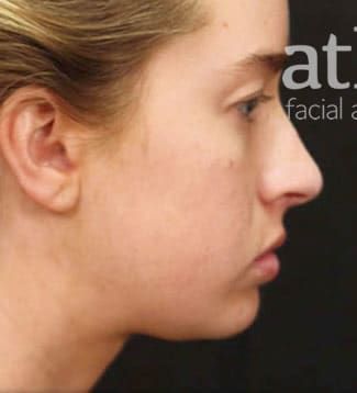Revision Rhinoplasty Before & After