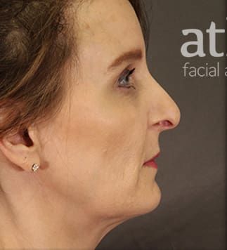 Revision Rhinoplasty Before & After