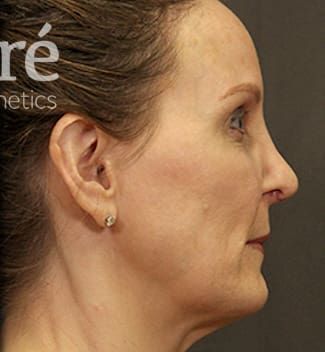 Revision Rhinoplasty Before & After