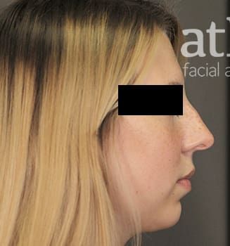 Revision Rhinoplasty Before & After